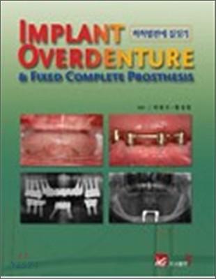 Implant overdenture : & Fixed complete prosthesis