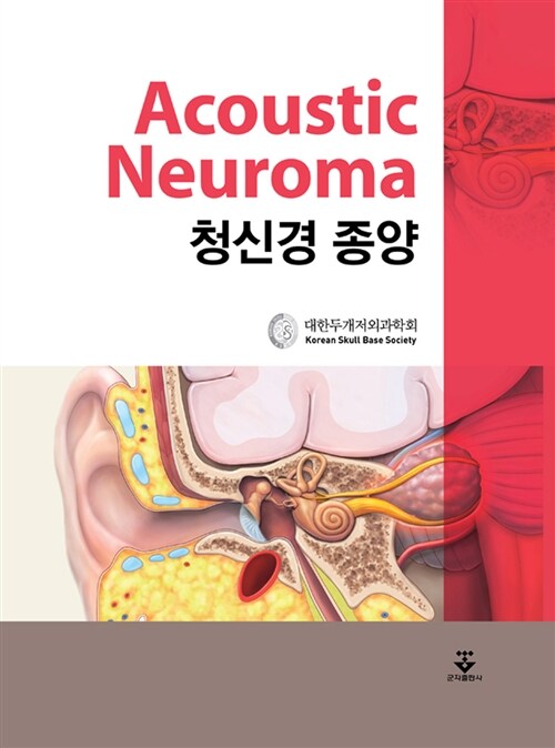 청신경 종양 =